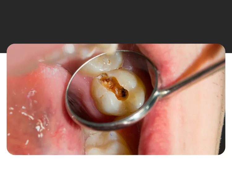 Antes y después del tratamiento de caries con empaste estético
