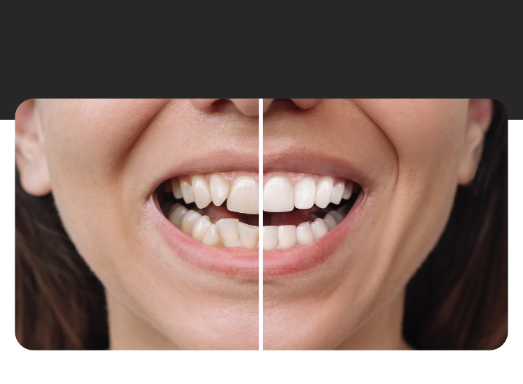 Carillas dentales para una sonrisa estética
