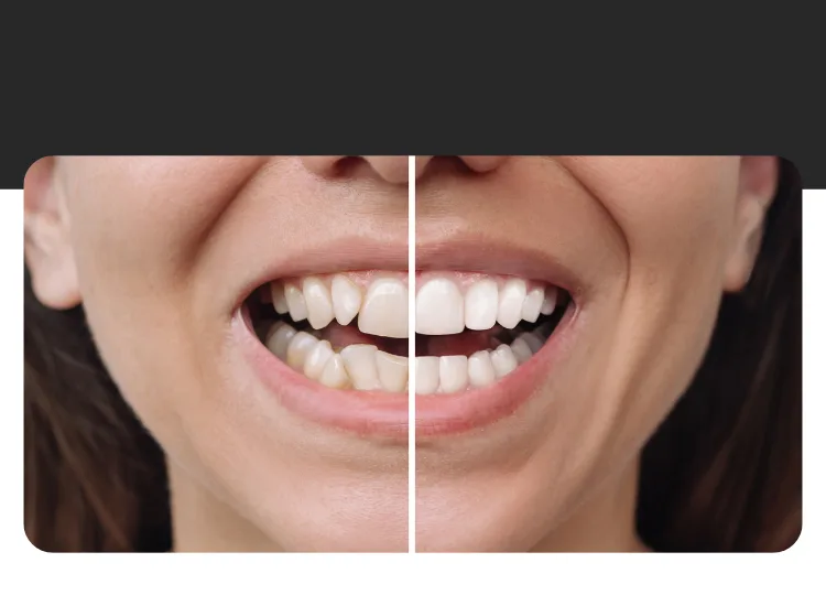 Carillas dentales para una sonrisa estética