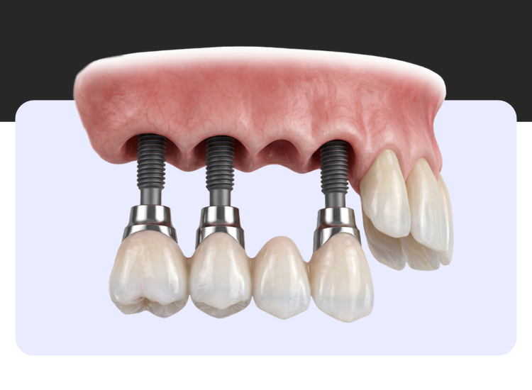Implante dental con corona sobre el hueso maxilar