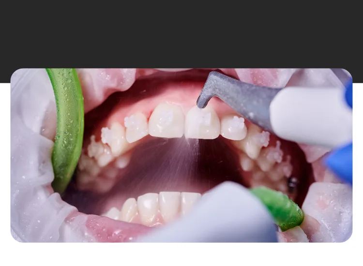 Antes y después de una limpieza dental profesional