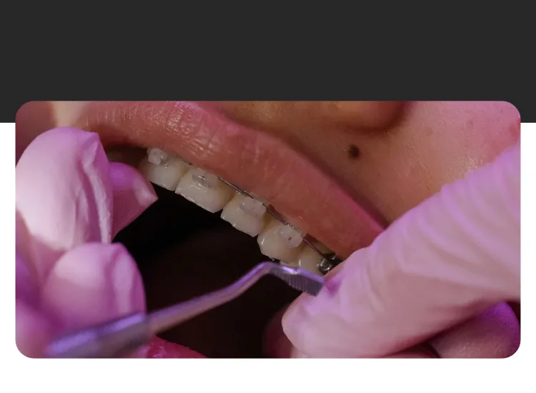 Alineadores transparentes de ortodoncia invisible