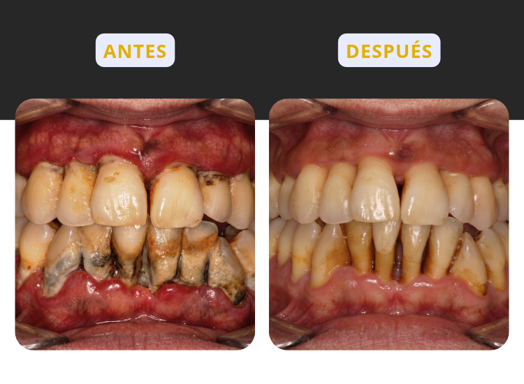 Antes y después de un tratamiento de periodontitis